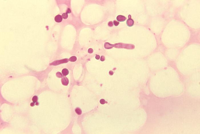 Seboroická dermatitída kvasinka Malassezia